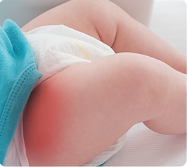 Diaper area irritation